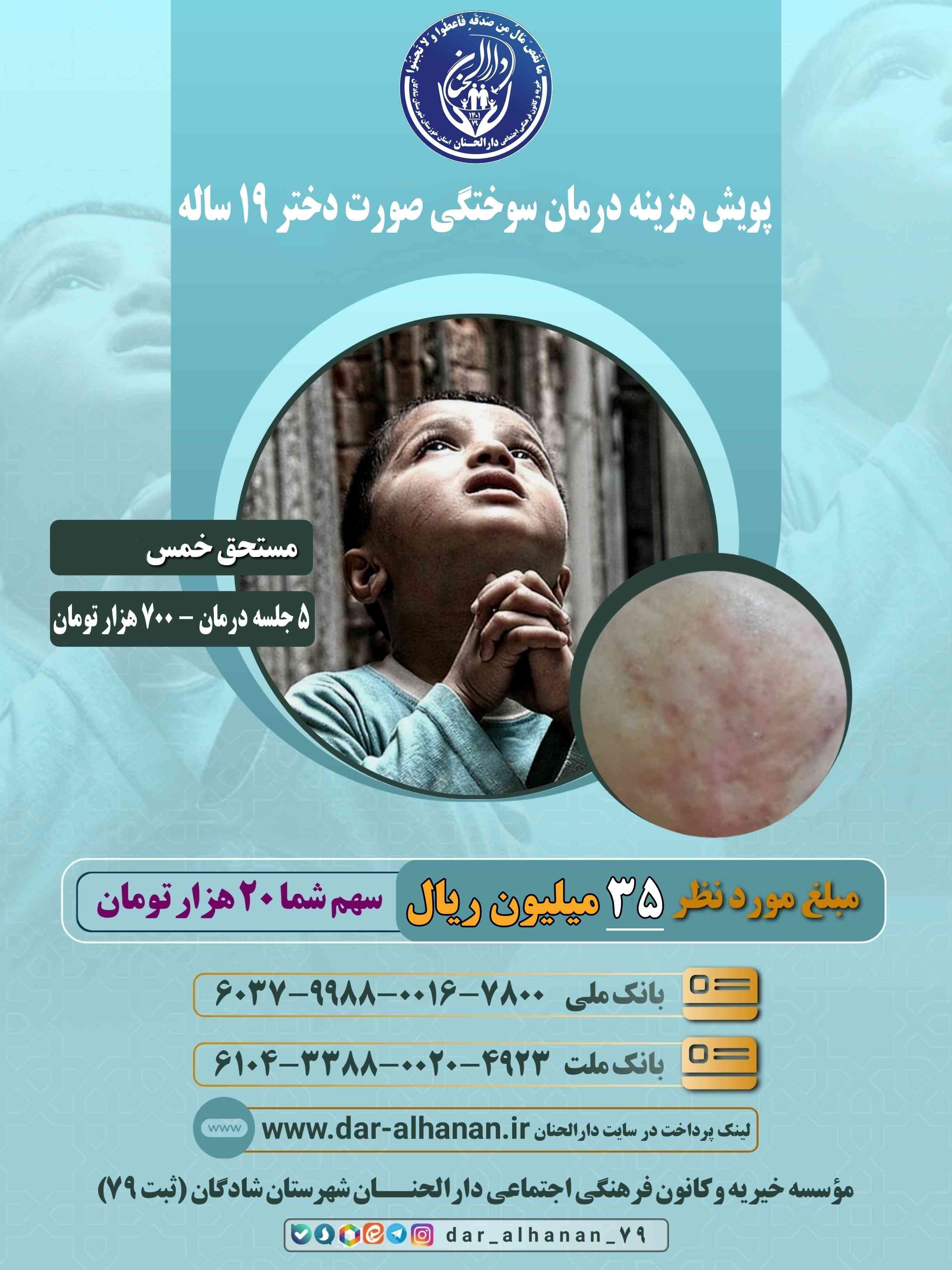 موسسه خیریه دارلحنان - پروژه: درمان سوختگی صورت دختر ۱۹ ساله